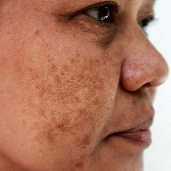 Laser para Manchas e Melasma